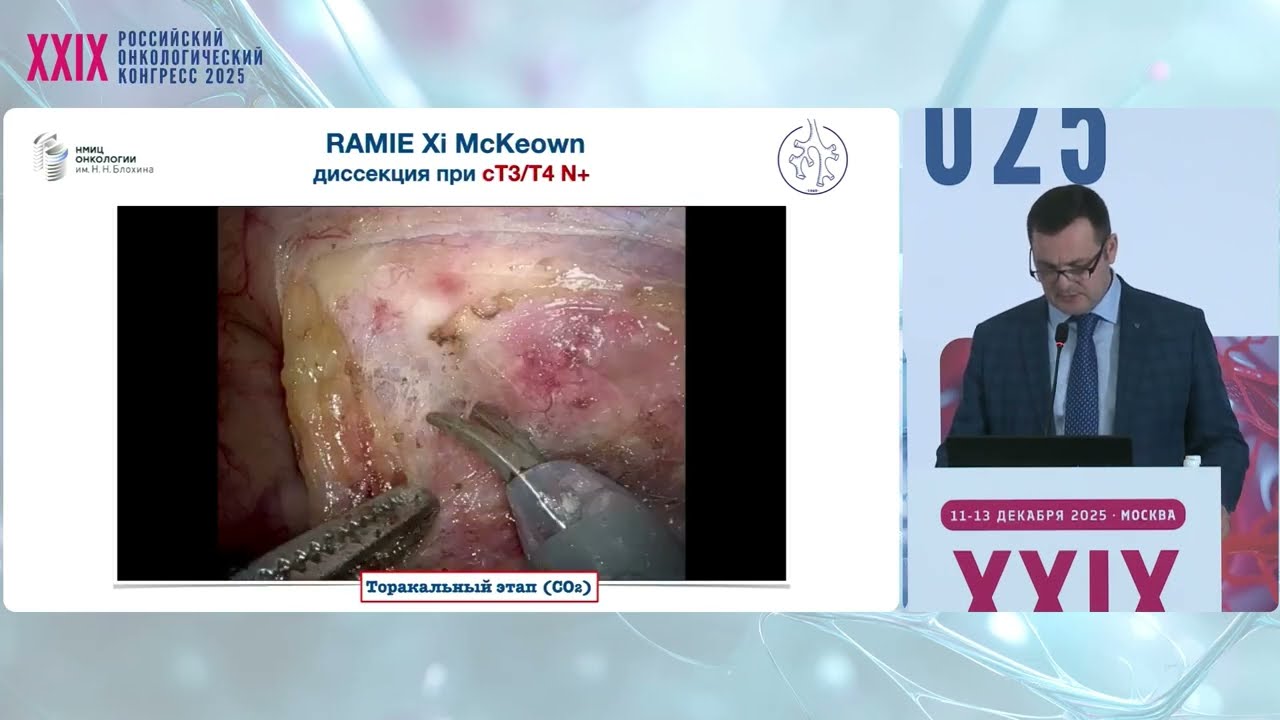 Резектабельный рак пищевода и желудка. RATS McKeown