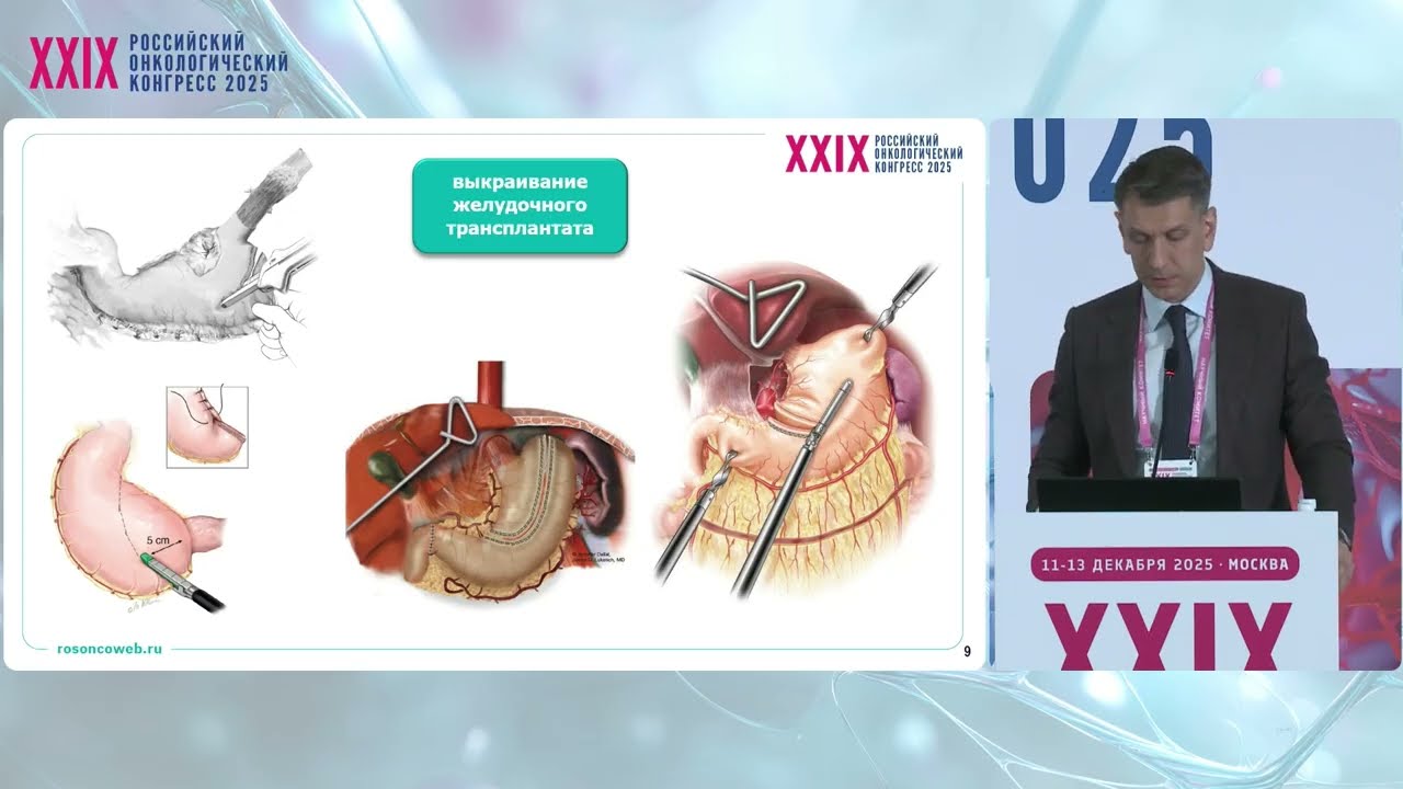 Резектабельный рак пищевода и желудка. RATS Ivor Lewis
