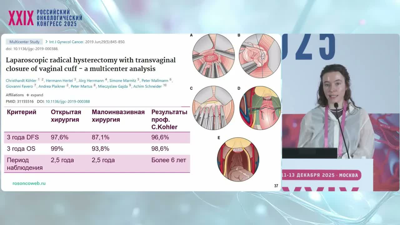 Исследование LACC: лапароскопическая и открытая радикальная гистерэктомия при раке шейки матки