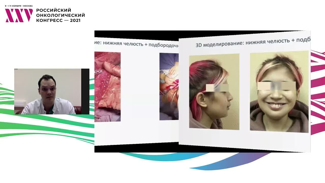 Применение технологии CAD/CAM при планировании реконструкции нижней челюсти