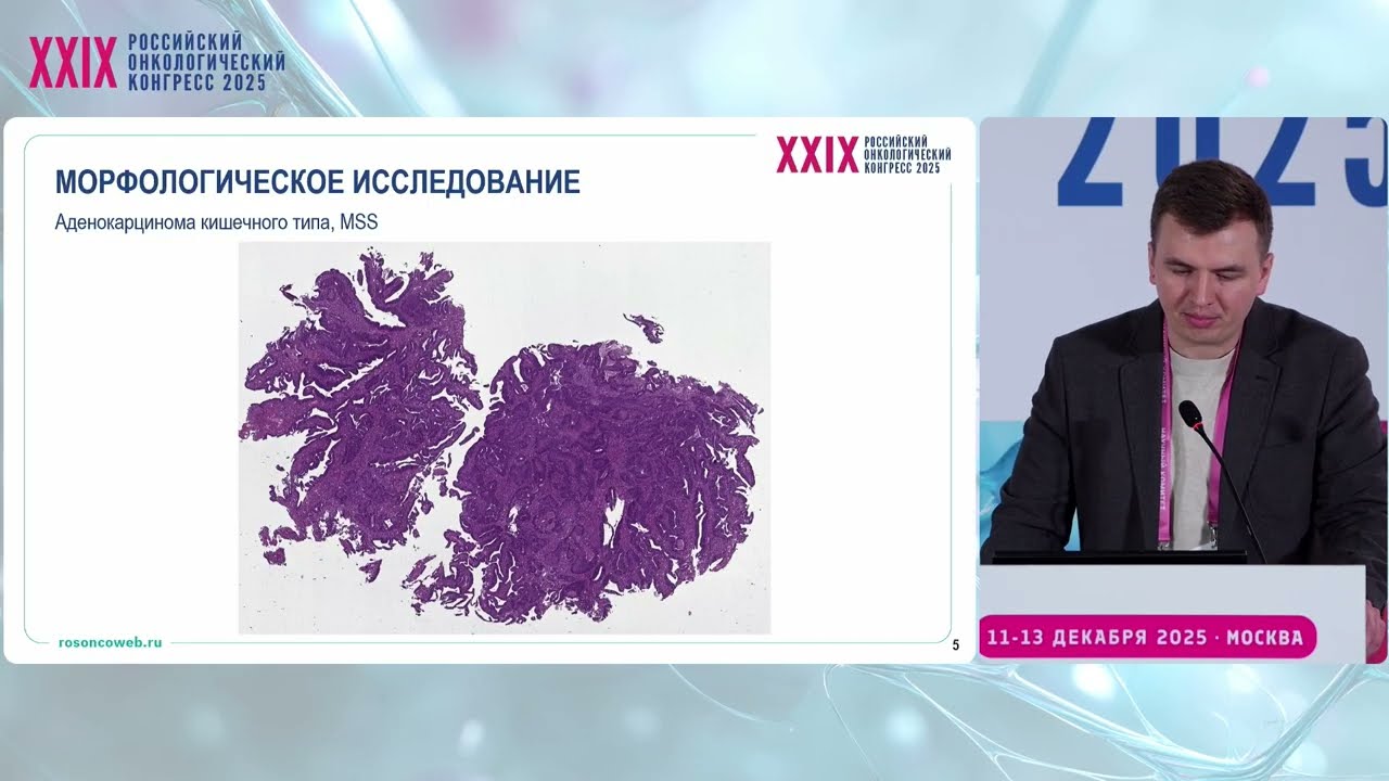 Клинический случай: Отказ от ЛТ при раке среднеампулярного отдела прямой кишки