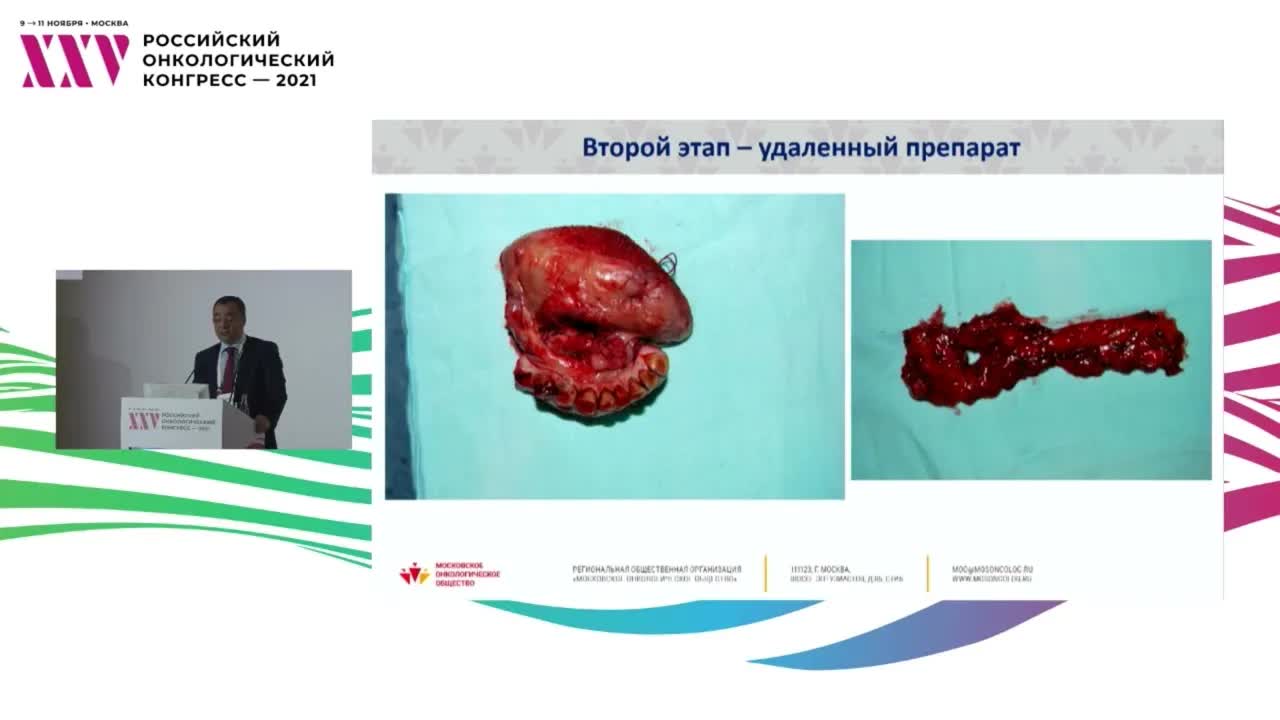 Операции на грани фола. Опухоль средостения, рак пищевода и языка, лейомиосаркома