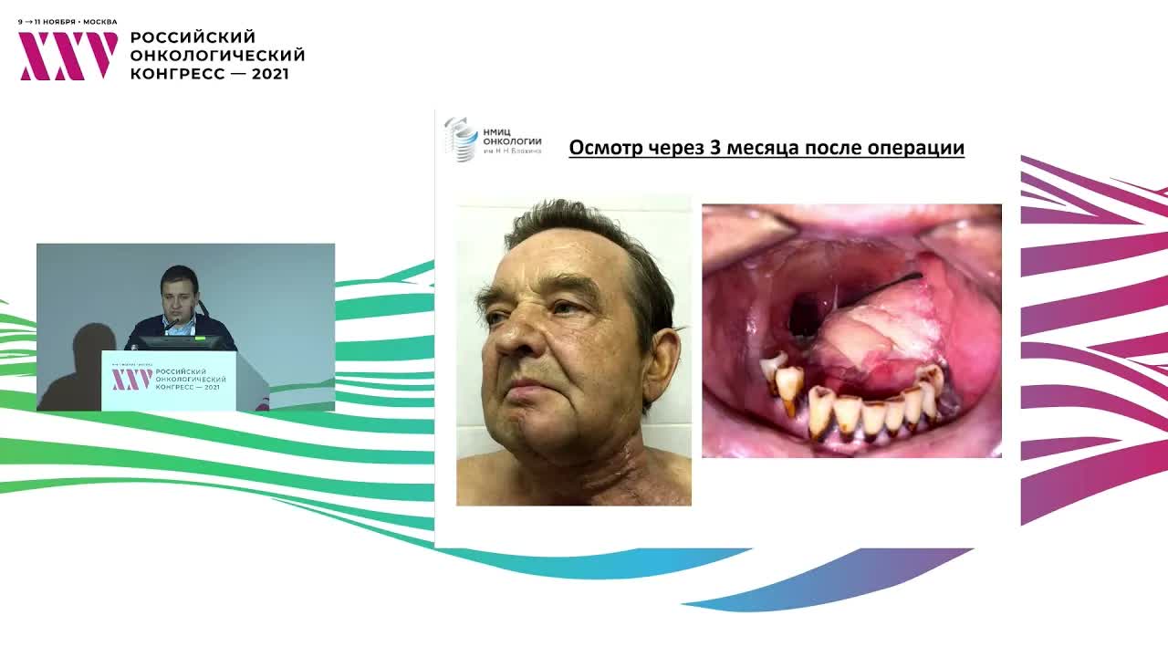 Рак слизистой оболочки полости рта. Субтотальная резекция языка. Применение лоскута с включением большой грудной мышцы