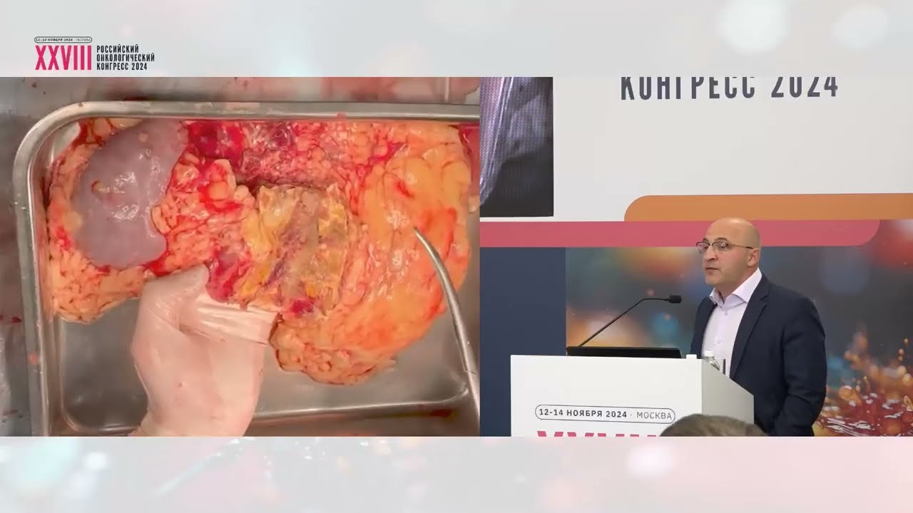 Гепатопанкреатобилиарная хирургия. Нюансы трансплантации печени