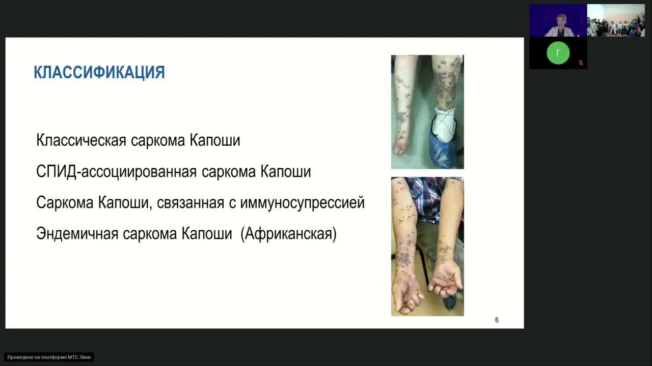 редкие опухоли. Саркома Капоши (вебинар 8 февраля 2024)