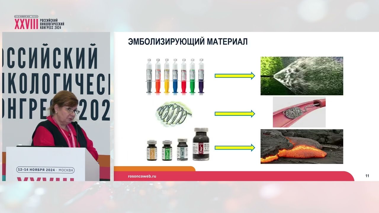 Эндоваскулярный гемостаз при кровотечениях из опухолей малого таза