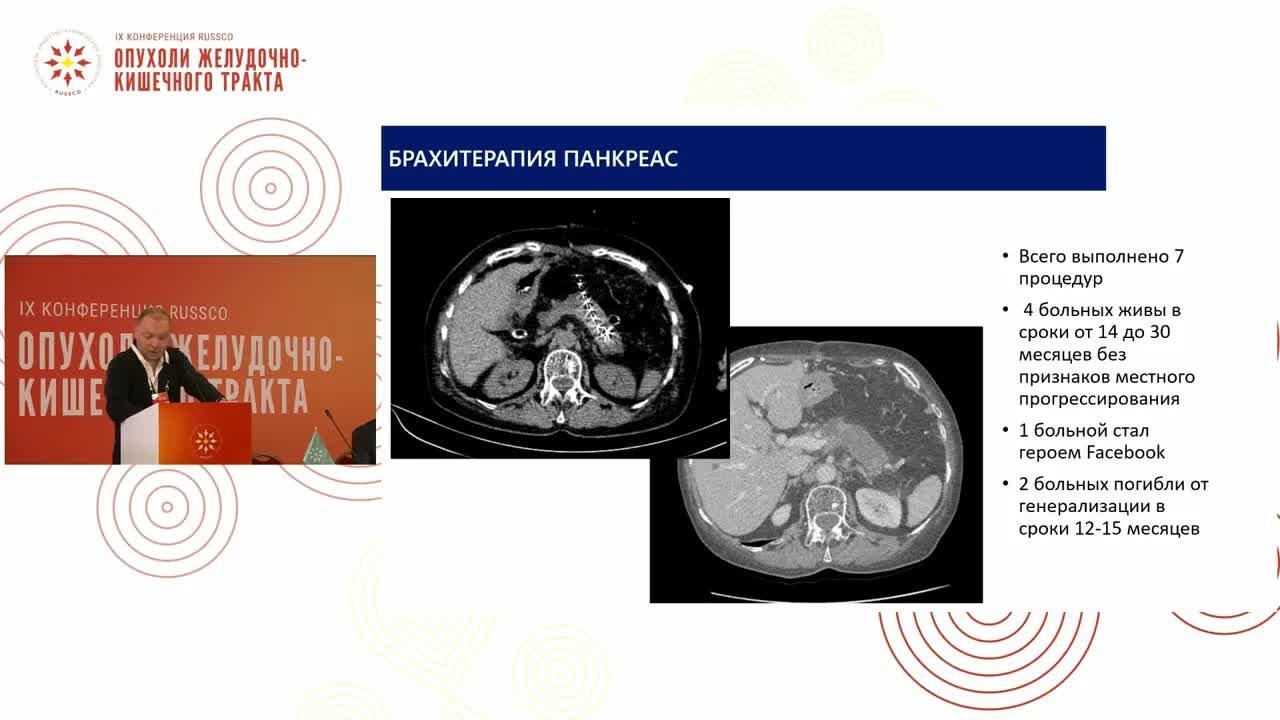 Пути повышения безопасности и эффективности в лечении больных раком поджелудочной железы