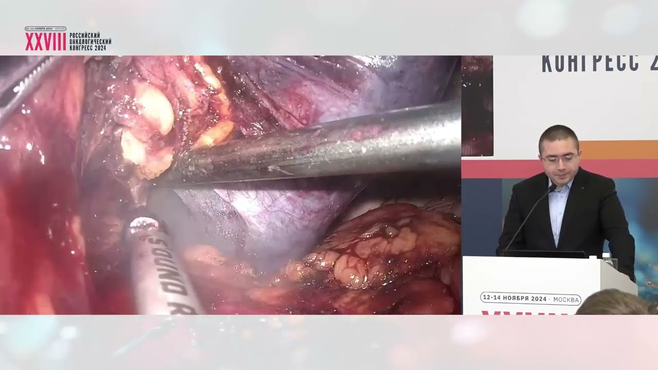 Сложные случаи в лапароскопической хирургии панкреатодуоденальной зоны