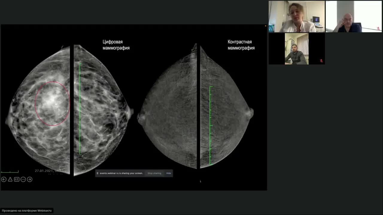 Современные принципы лучевой диагностики и хирургического лечения РМЖ. От простого к сложному
