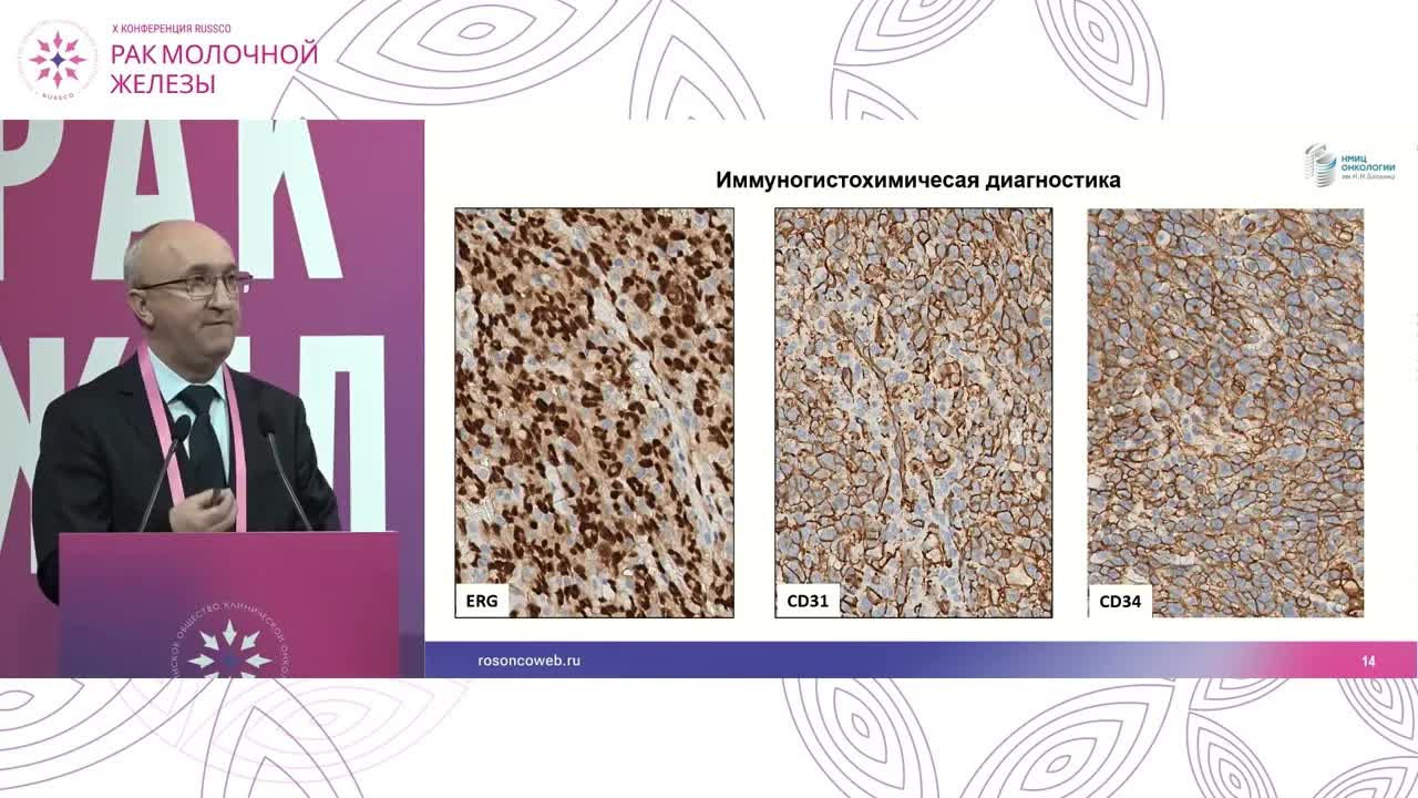 редкие ситуации в лечении РМЖ. Ангиосаркомы молочной железы: слово морфологу