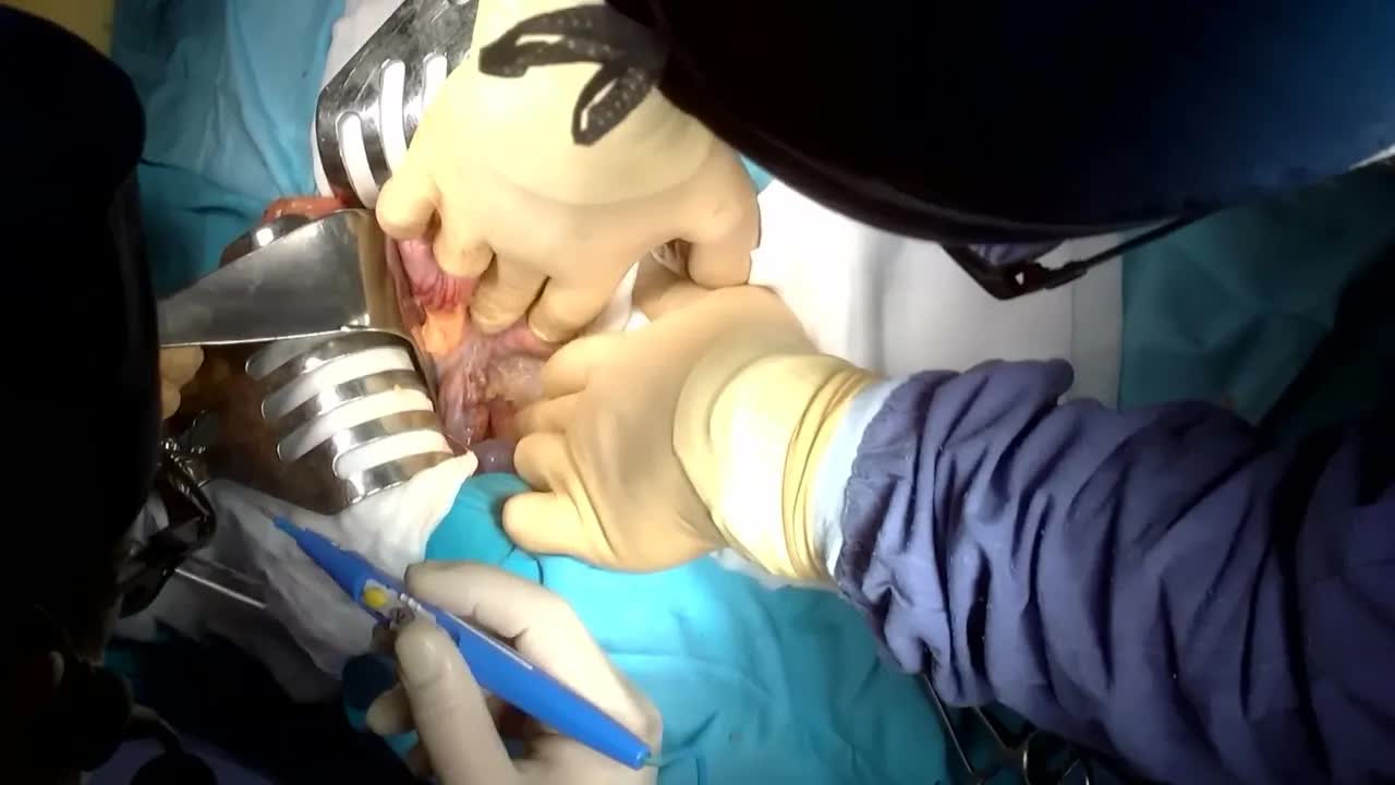 Трансляция из операционной: панкреатодуоденальная резекция. Полная запись операции