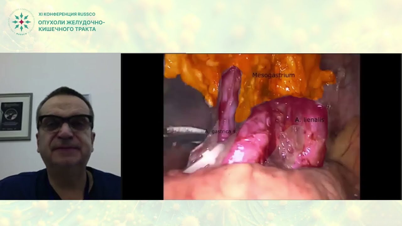 Технические аспекты выполнения лимфодиссекции при лапароскопической гастрэктомии