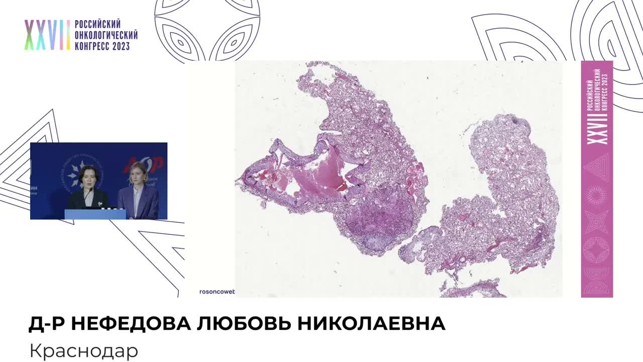 Диагностические ловушки. Под маской метастатического поражения легкого