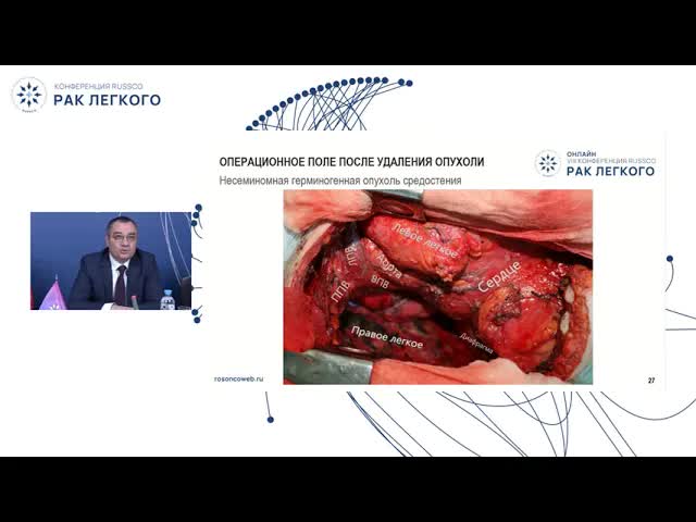 Хирургическое лечение редких опухолей внутригрудной локализации (клинические наблюдения)