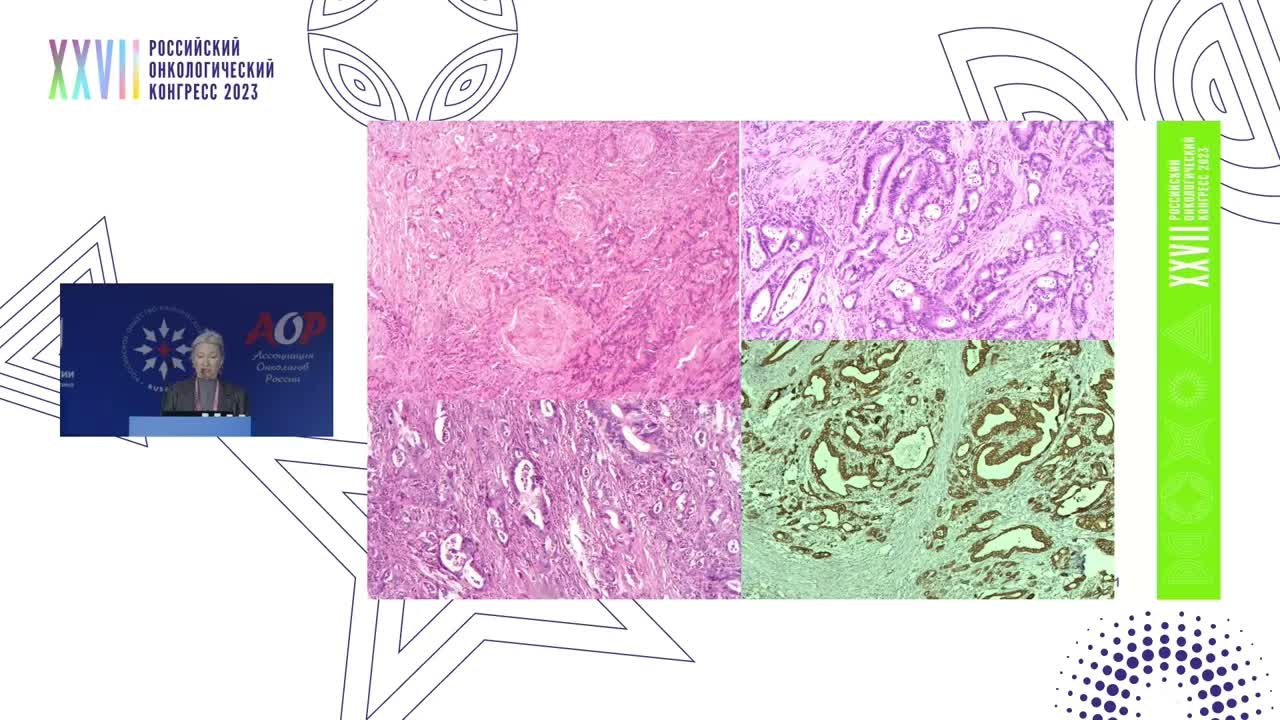 Диагностические ловушки. Морфологические узоры рака панкреас при описторхозной инвазии. Патолог