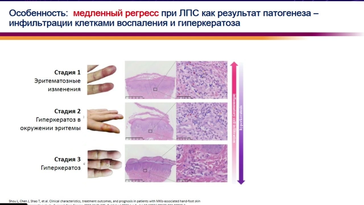 Мифы и реальность: иммунотаргетная терапия и развитие кожной токсичности (вебинар 27 июня 2025)