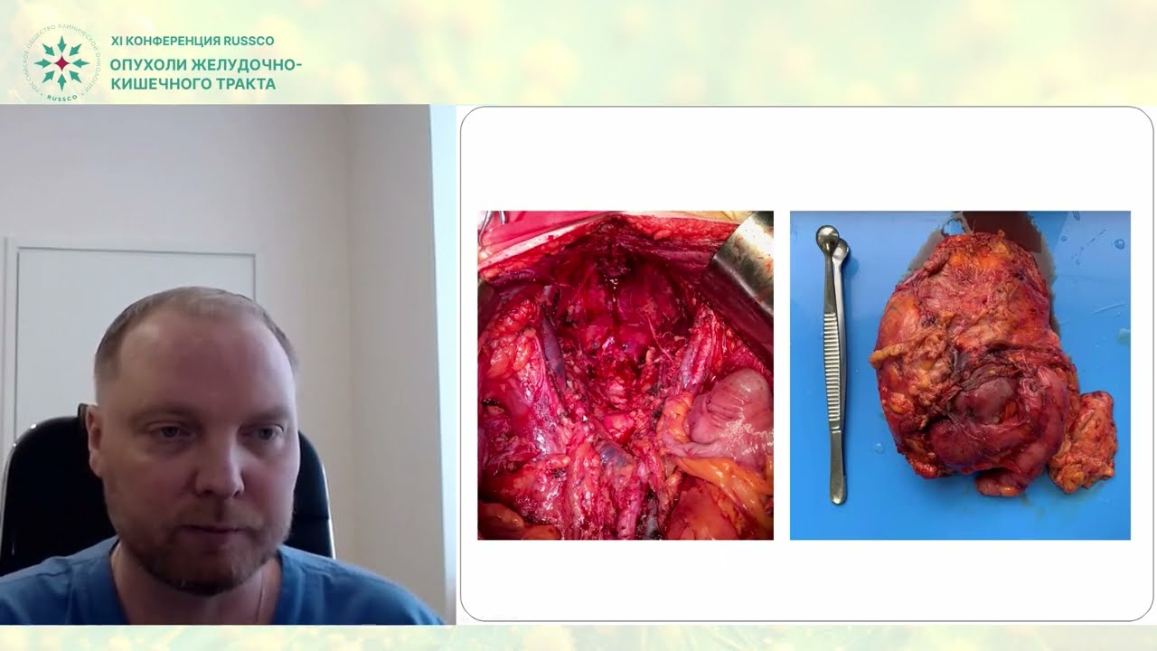 Мультивисцеральные тазовые резекции при раке прямой кишки – старые песни о главном