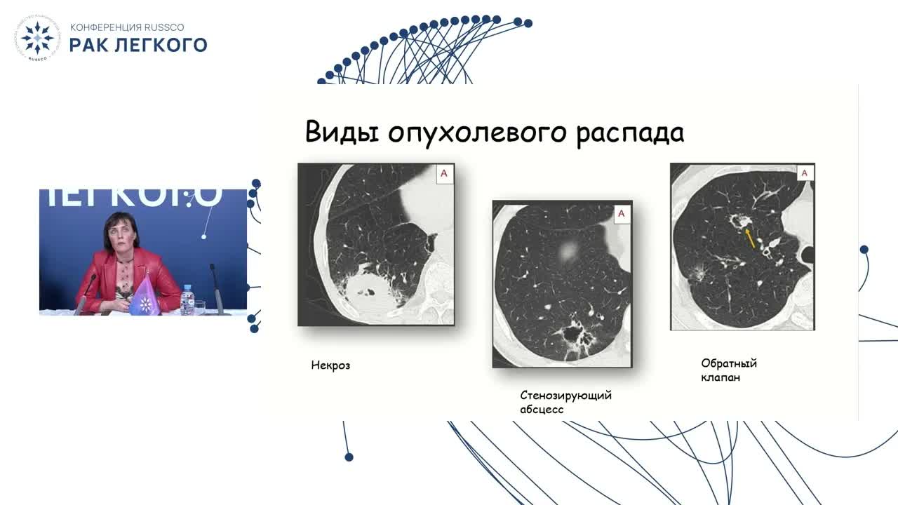 Полоса препятствий для радиотерапевта: инвазия опухоли легкого в крупные сосуды, кровохаркание, ателектаз, распад