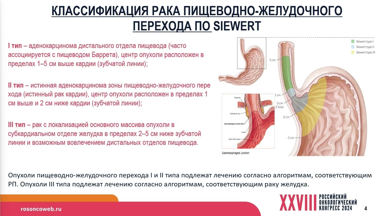 Лучевая/химиолучевая терапия при кардиоэзофагеальном раке: можно ли расставить точки над i?