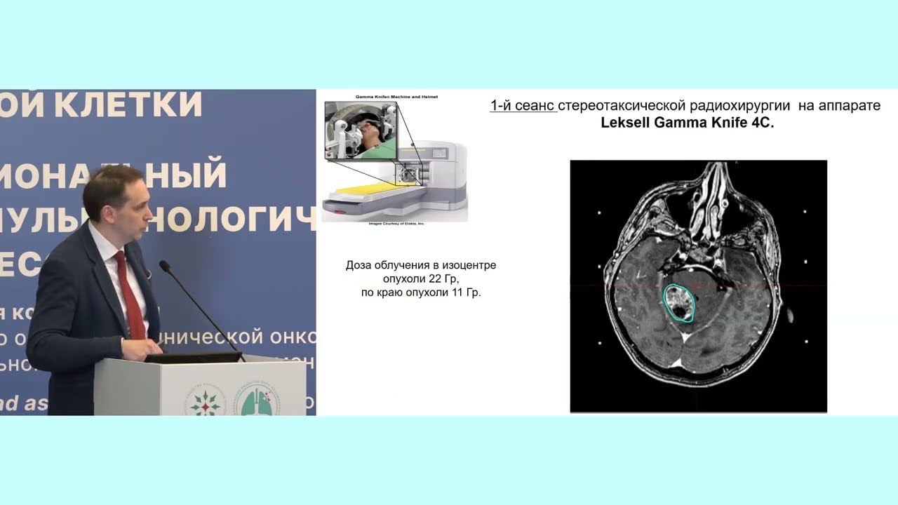 Возможности лучевой терапии в лечении олигометастатического рака легкого