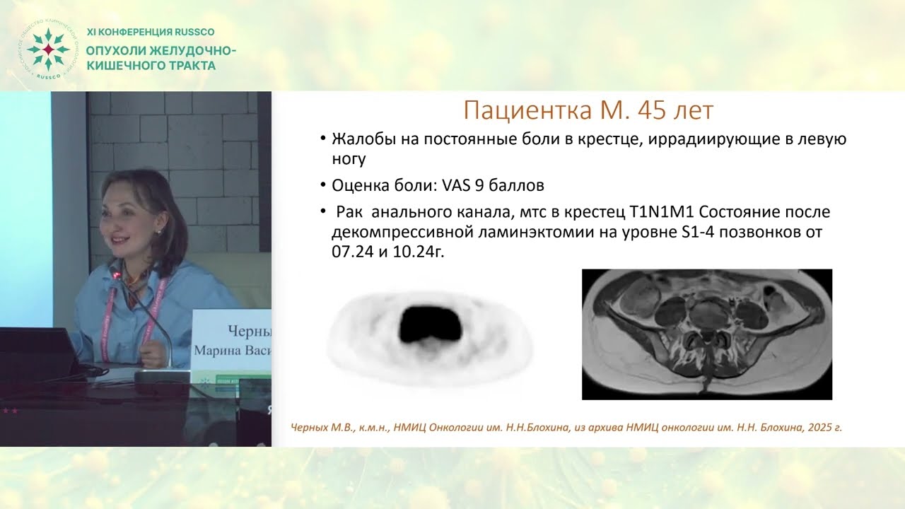 Нужна ли лучевая терапия при метастатическом раке анального канала: мнение за