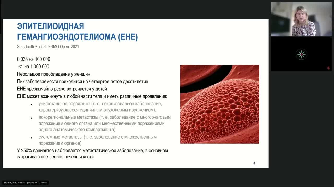 Редкие опухоли. Эпителиоидная гемангиоэндотелиома (вебинар 11 сентября 2024)