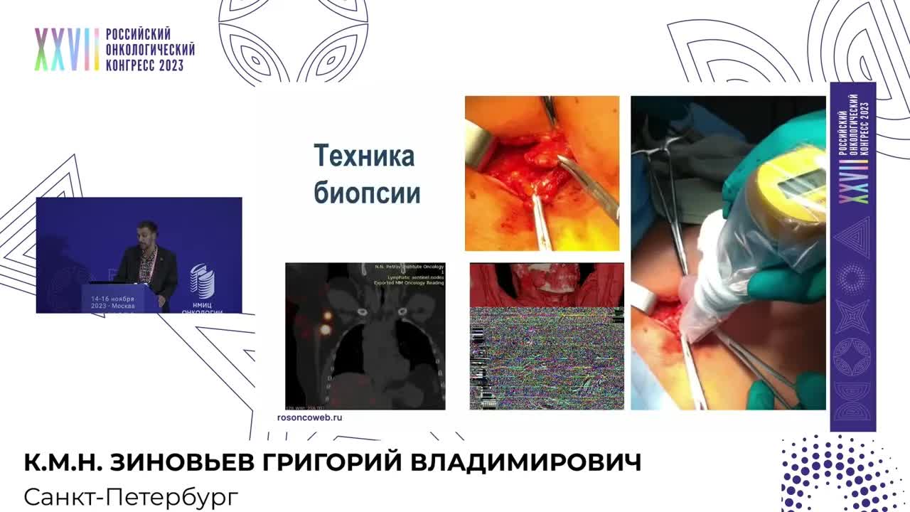 Биопсия сторожевого лимфоузла при меланоме