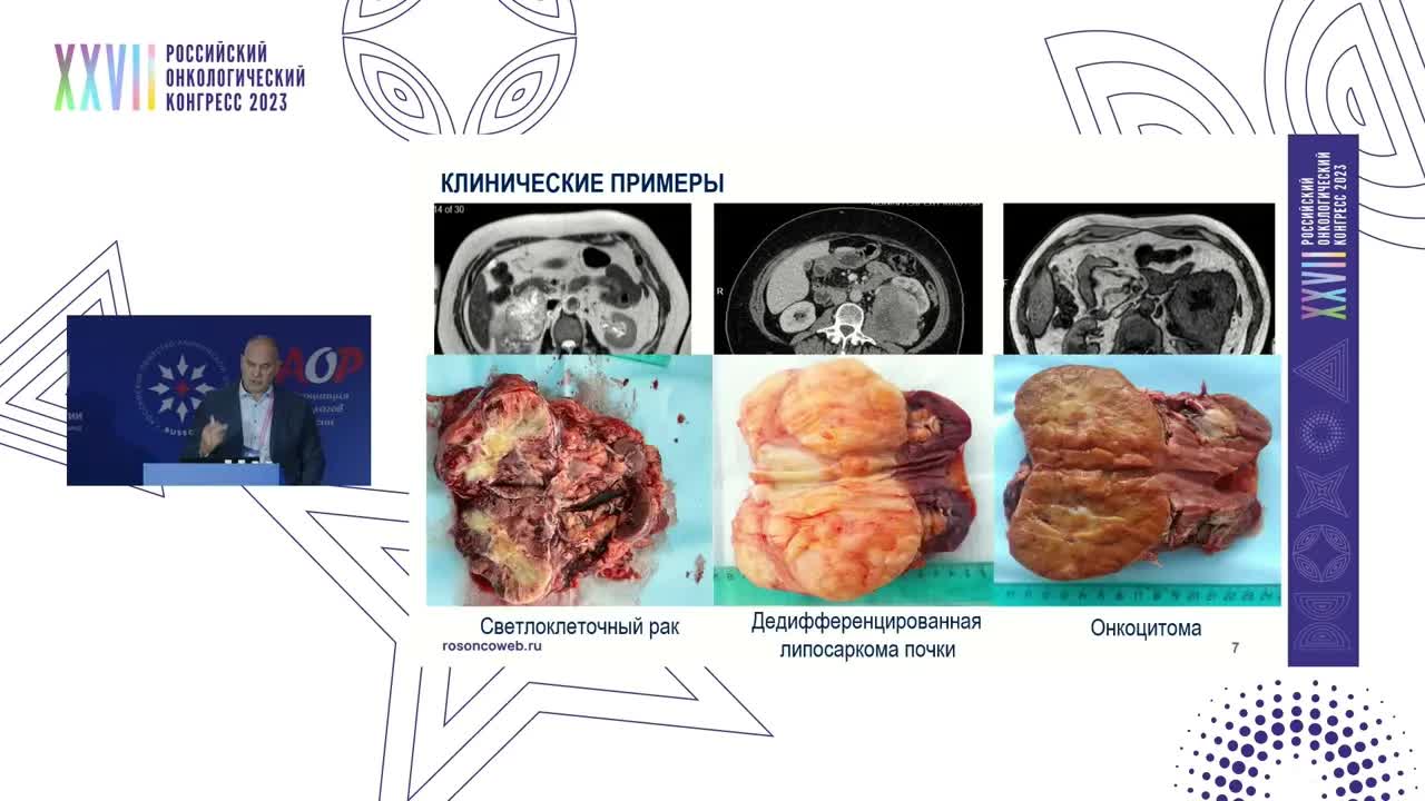 Диагностические ловушки. Случай редкой мягкотканной опухоли почки, имитирующей рак