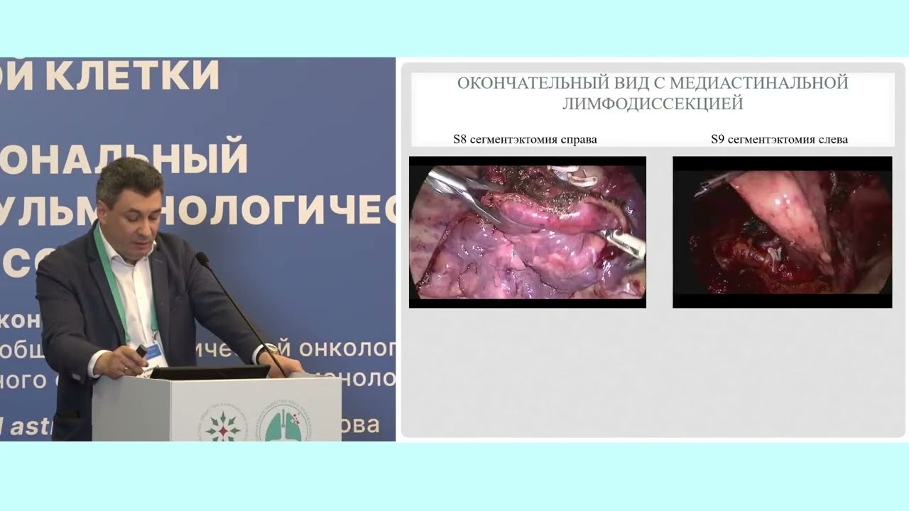 «Сложные» сегментэктомии: Левицкий А.В.