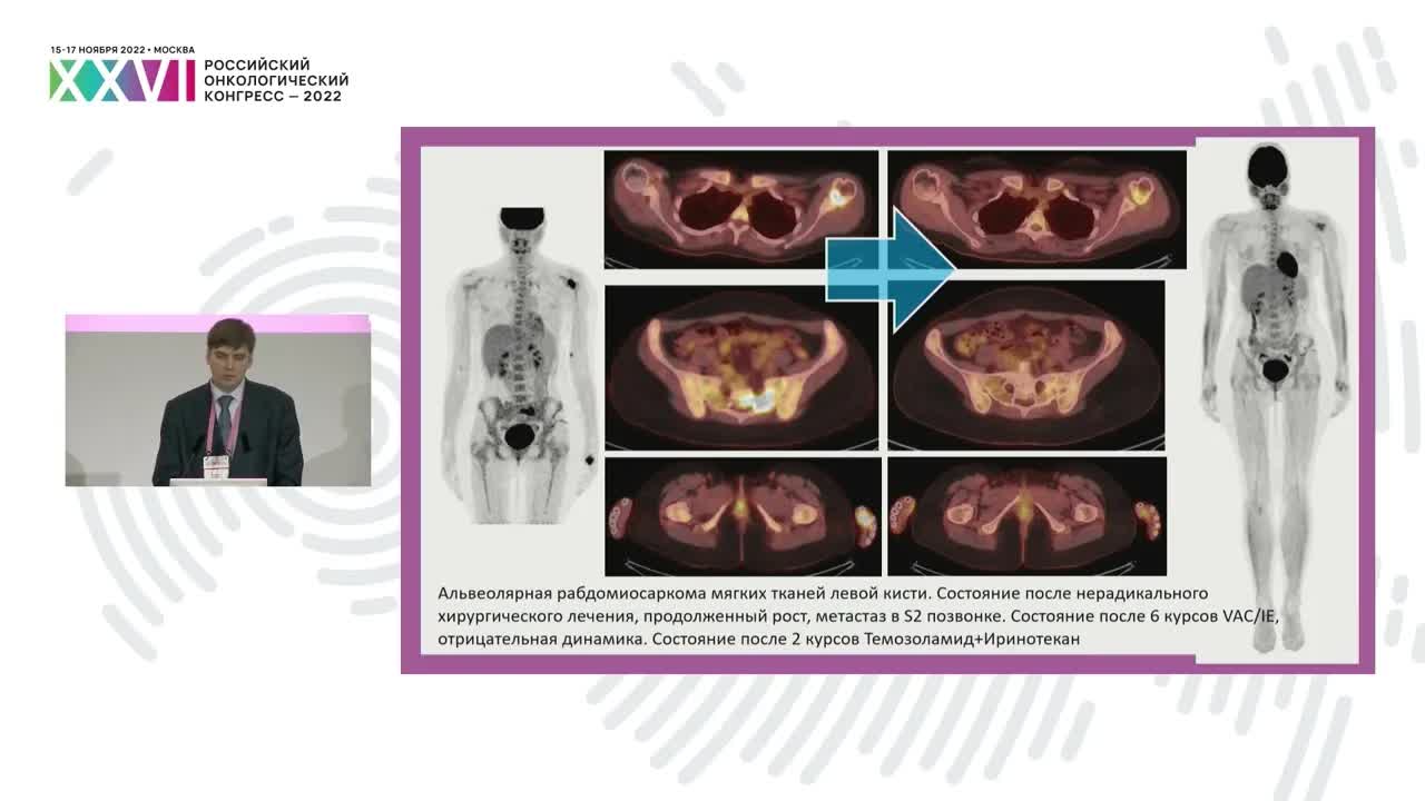 Особенности ПЭТ-КТ диагностики сарком мягких тканей и костей