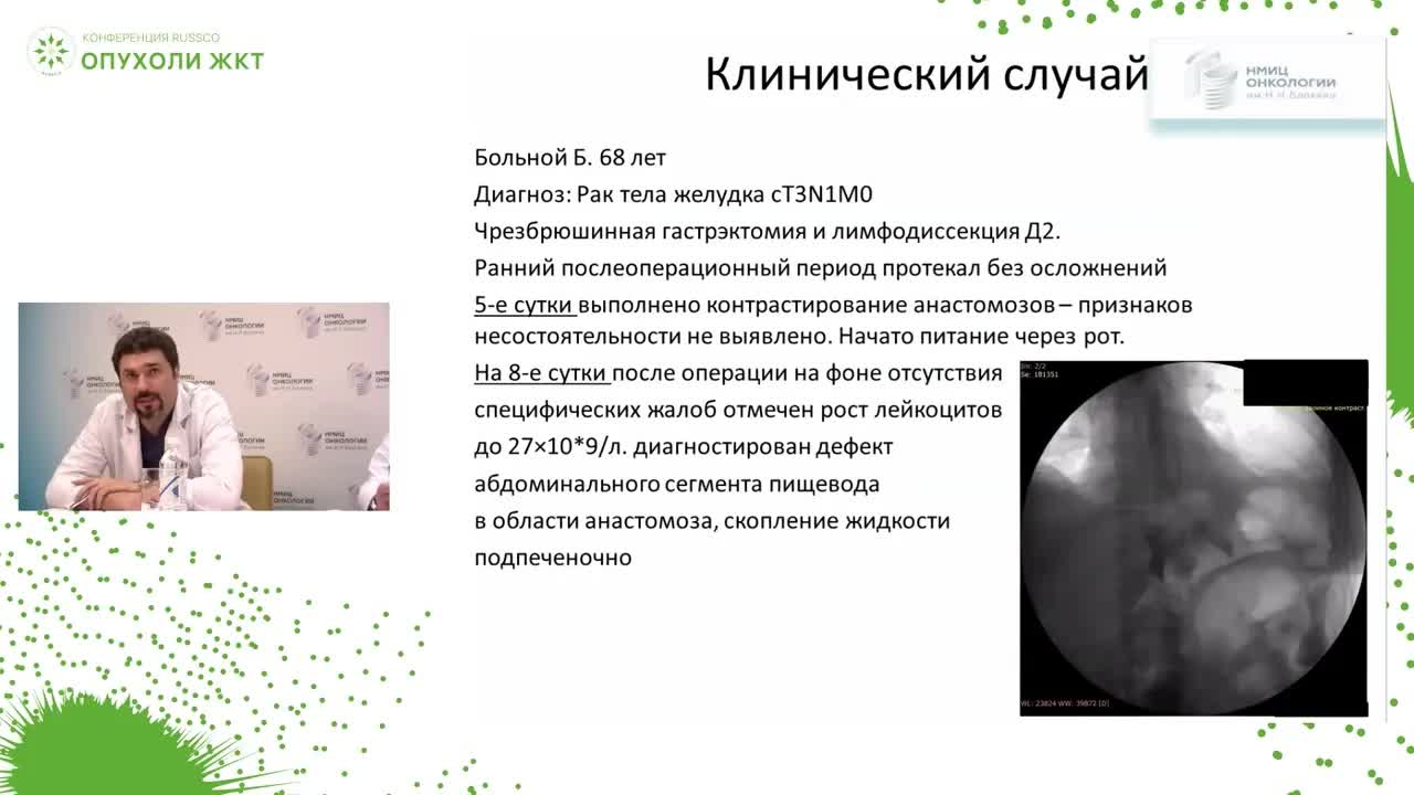 Опыт применения VAC-системы при несостоятельности пищеводно-кишечного анастомоза