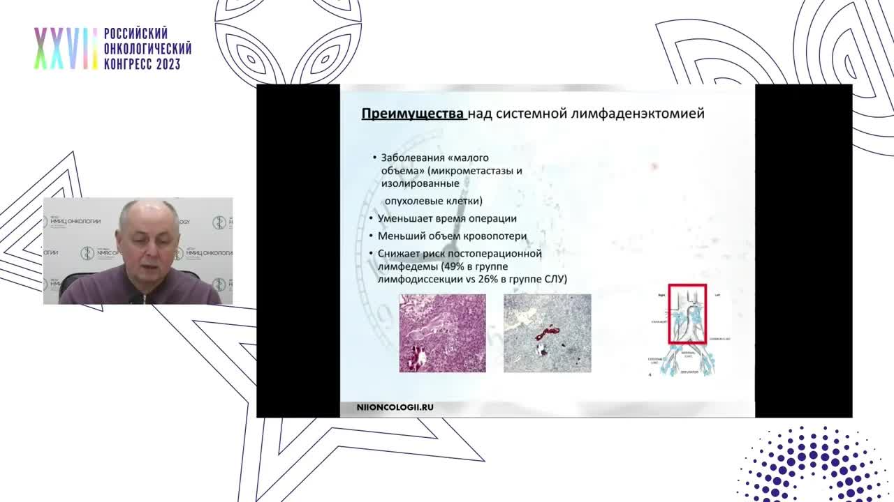 Биопсия сторожевого лимфоузла в онкогинекологии