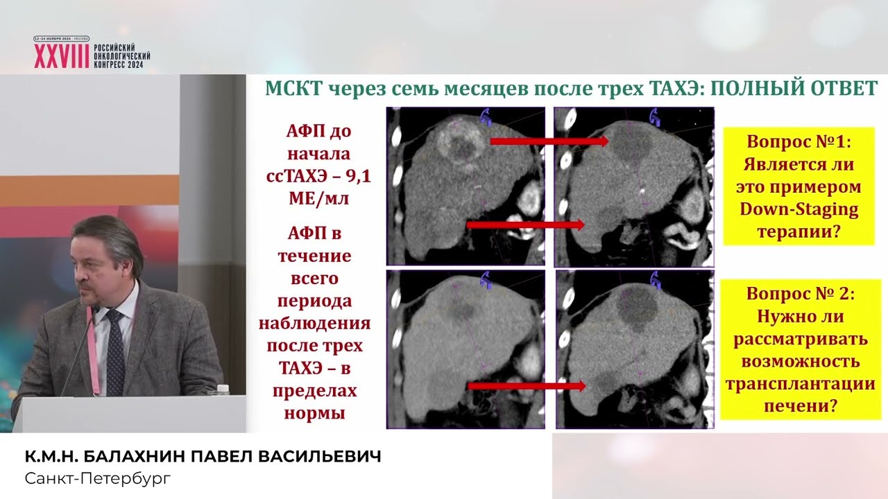 Классика Down-Staging при ГЦР: новое или хорошо забытое старое?