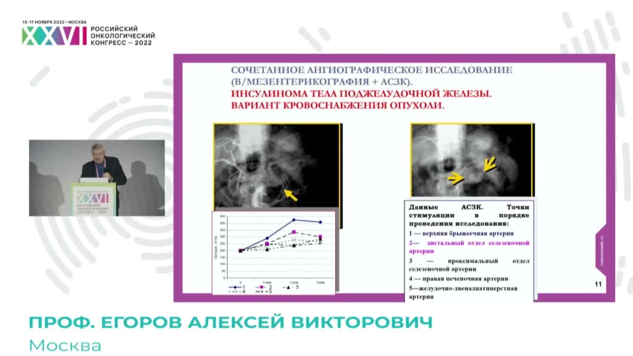 Современные принципы диагностики и лечения инсулин-продуцирующих опухолей поджелудочной железы