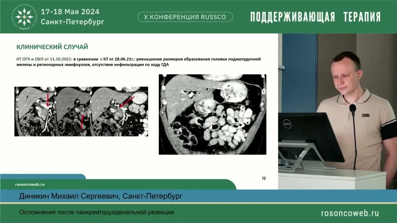 Осложнения после панкреатодуоденальной резекции