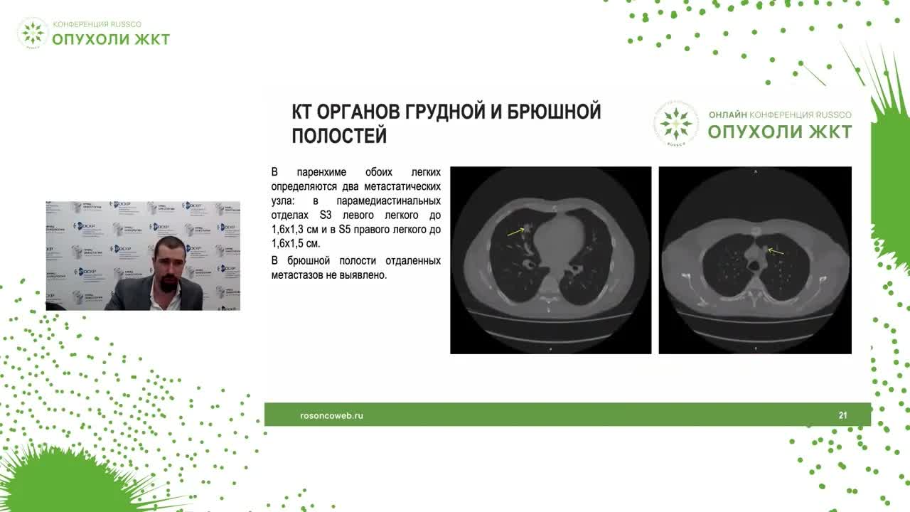 Хирургия рака прямой кишки. Клинический случай 1