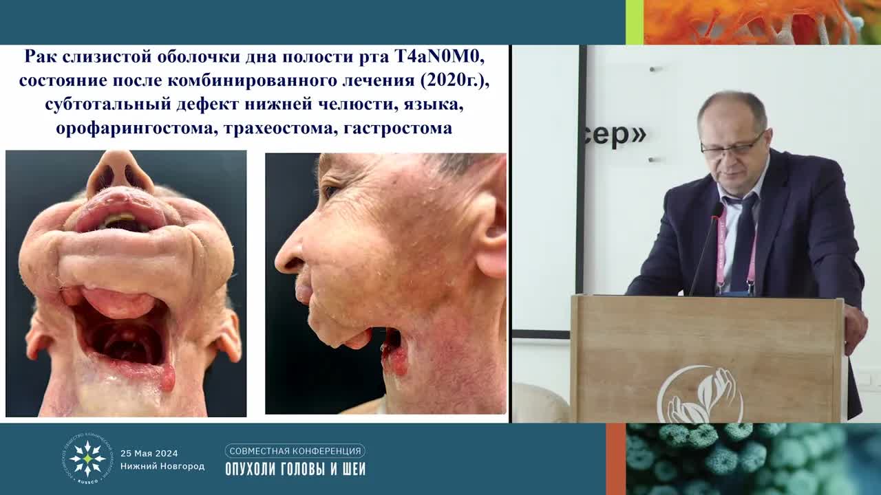 Реконструкция нижней челюсти при первичных и вторичных опухолях. Показания, методы, результаты