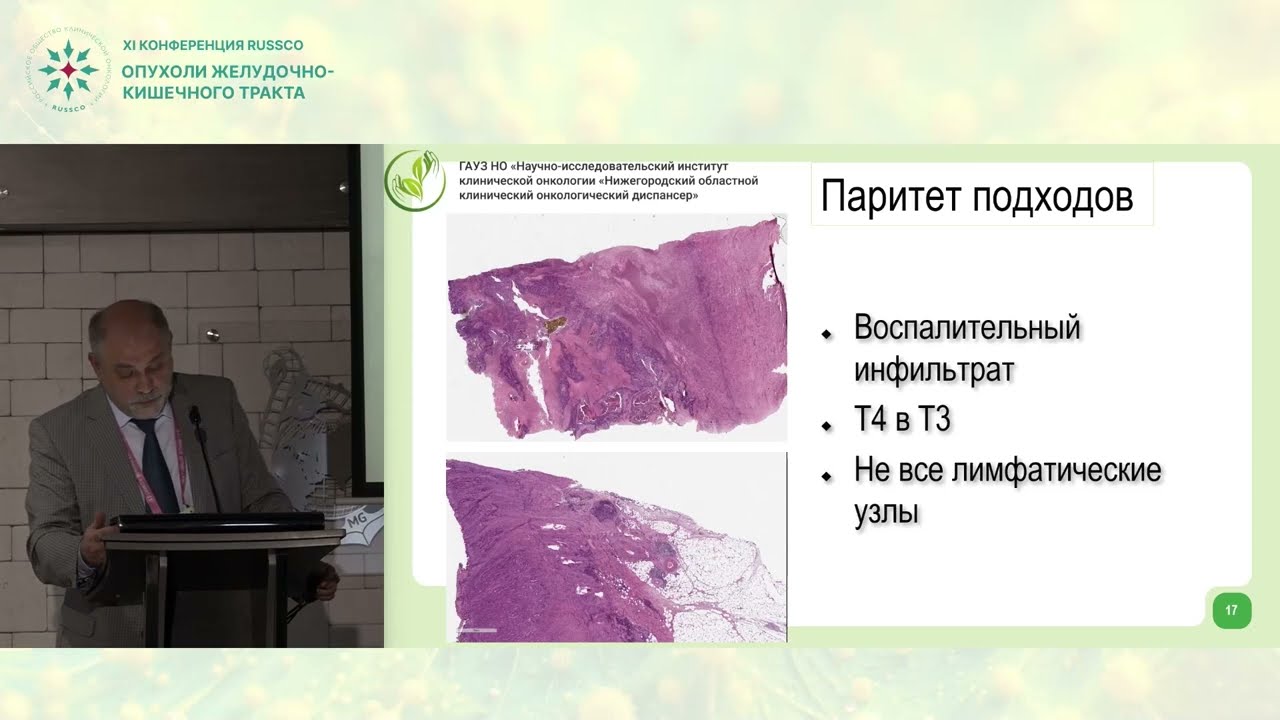 Местнораспространенный рак левой половины толстой кишки - LS стома или R0 резекция