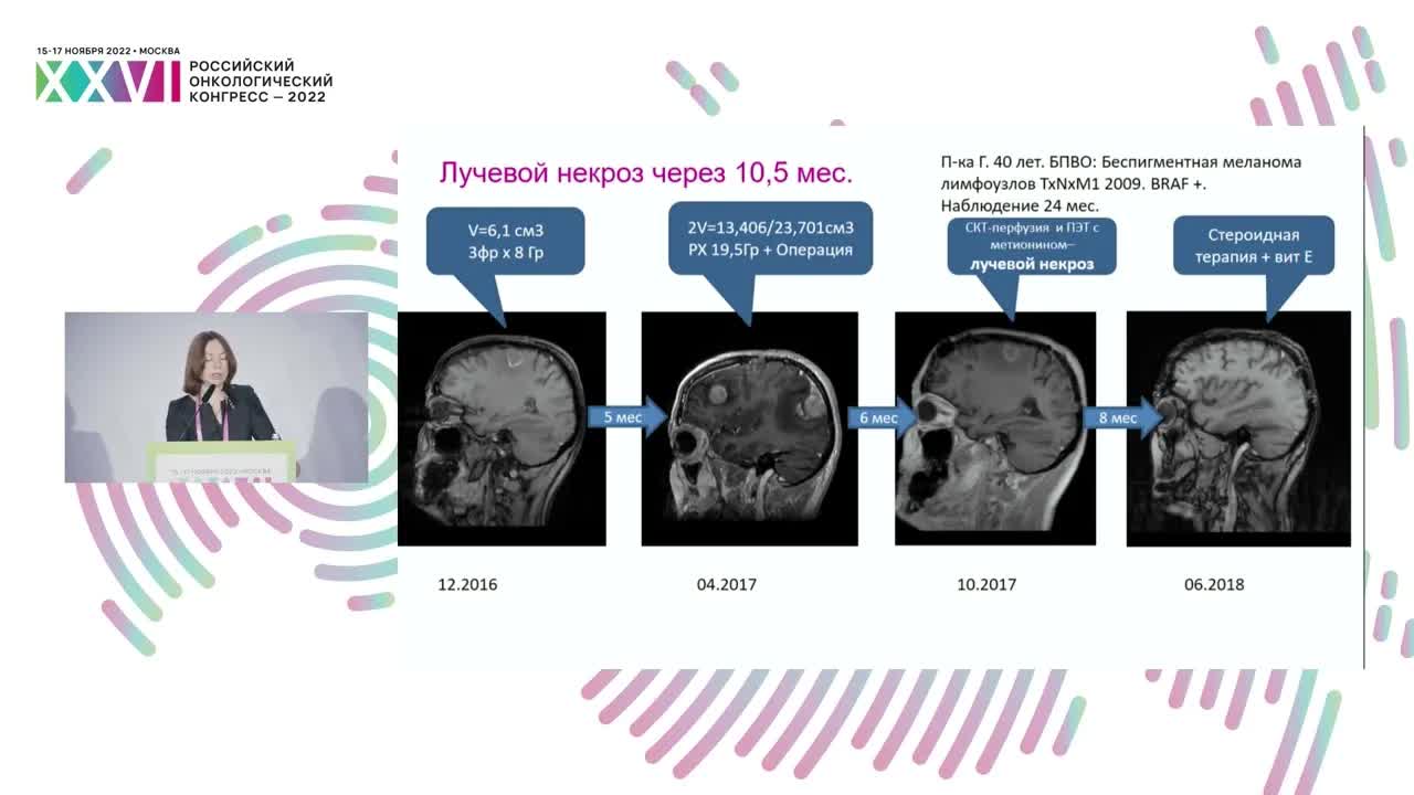 Стереотаксическая радиотерапия крупных метастазов: альтернатива или дополнение к нейрохирургии?