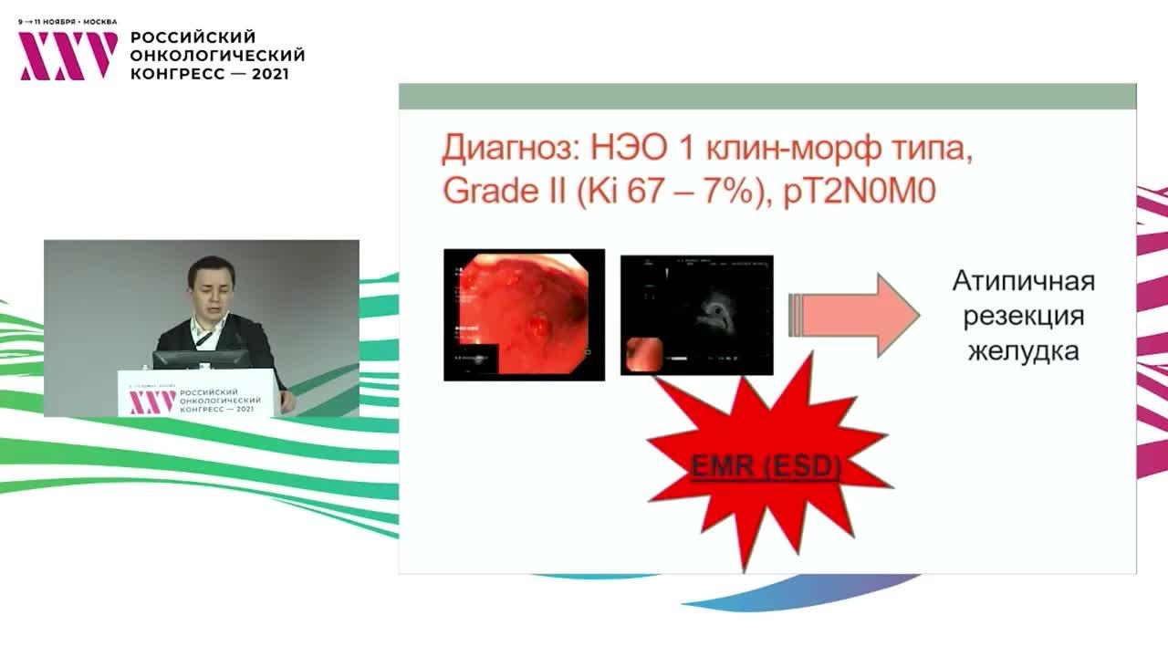 Хирургия нейроэндокринных опухолей желудка