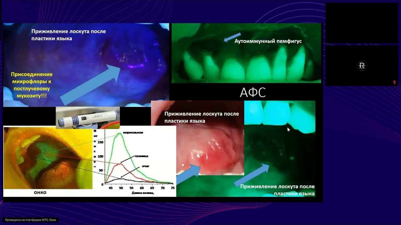 Клиника, диагностика, лечение и профилактика стоматологических осложнений ХЛТ и ИТ (1 июля 2025)