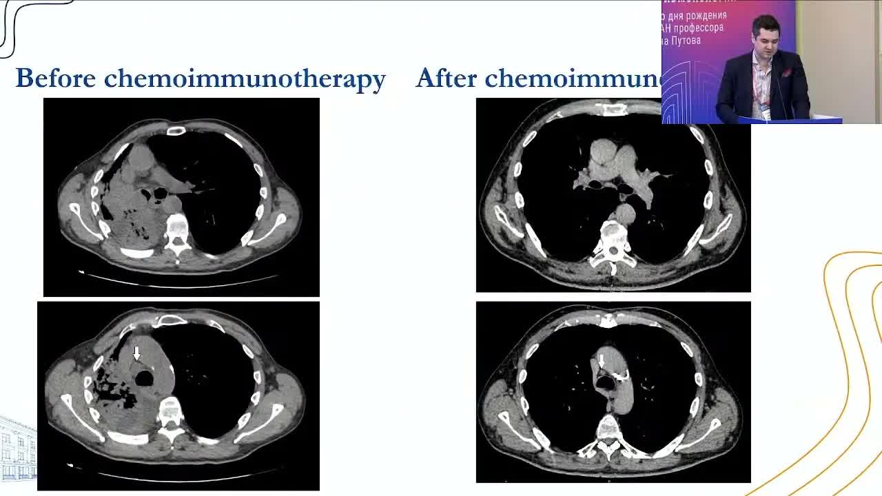 Возможности малоинвазивной хирургии рака легкого в эру иммунотерапии