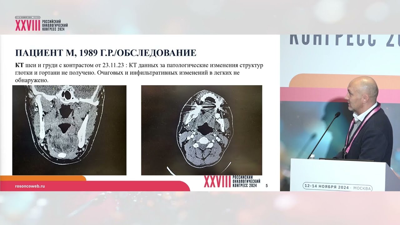 Редкая опухоль языка