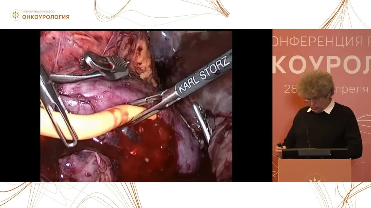 Разбор клинических случаев по хирургическим подходам и лучевой терапии в лечении метастатического рака почки