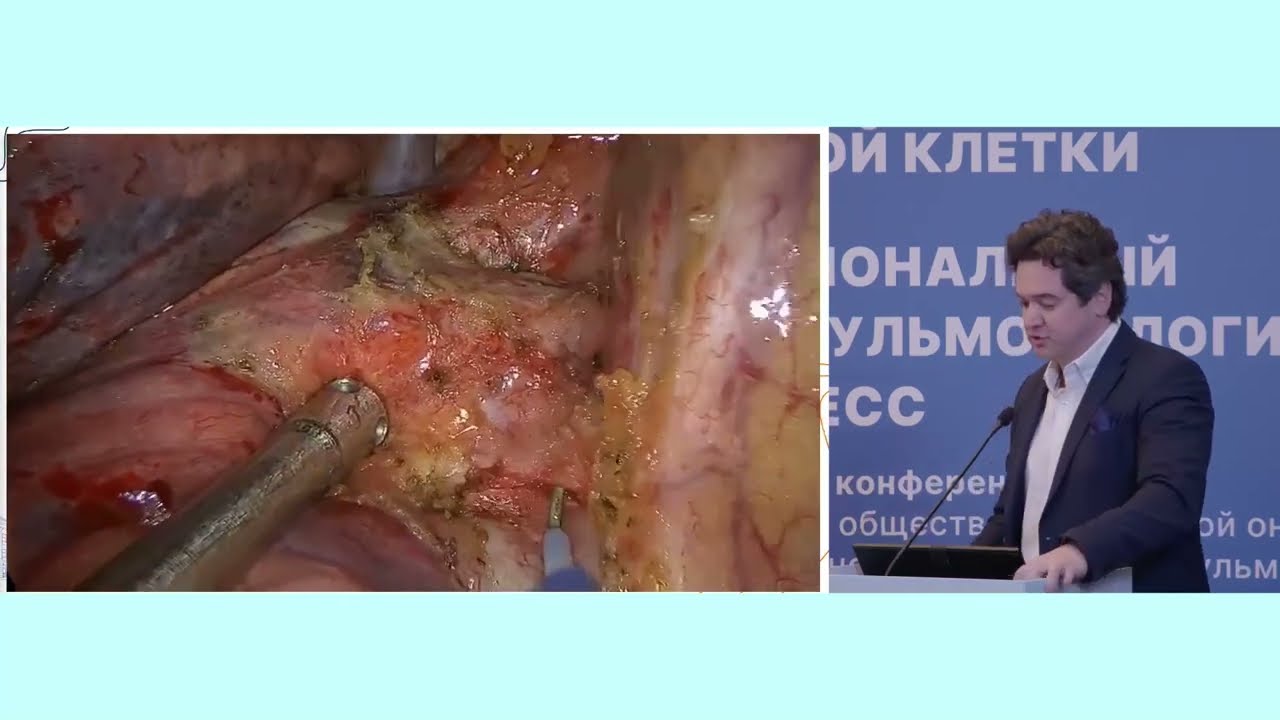 Особенности хирургического этапа лечения локализованного рака легкого после неоИХТ