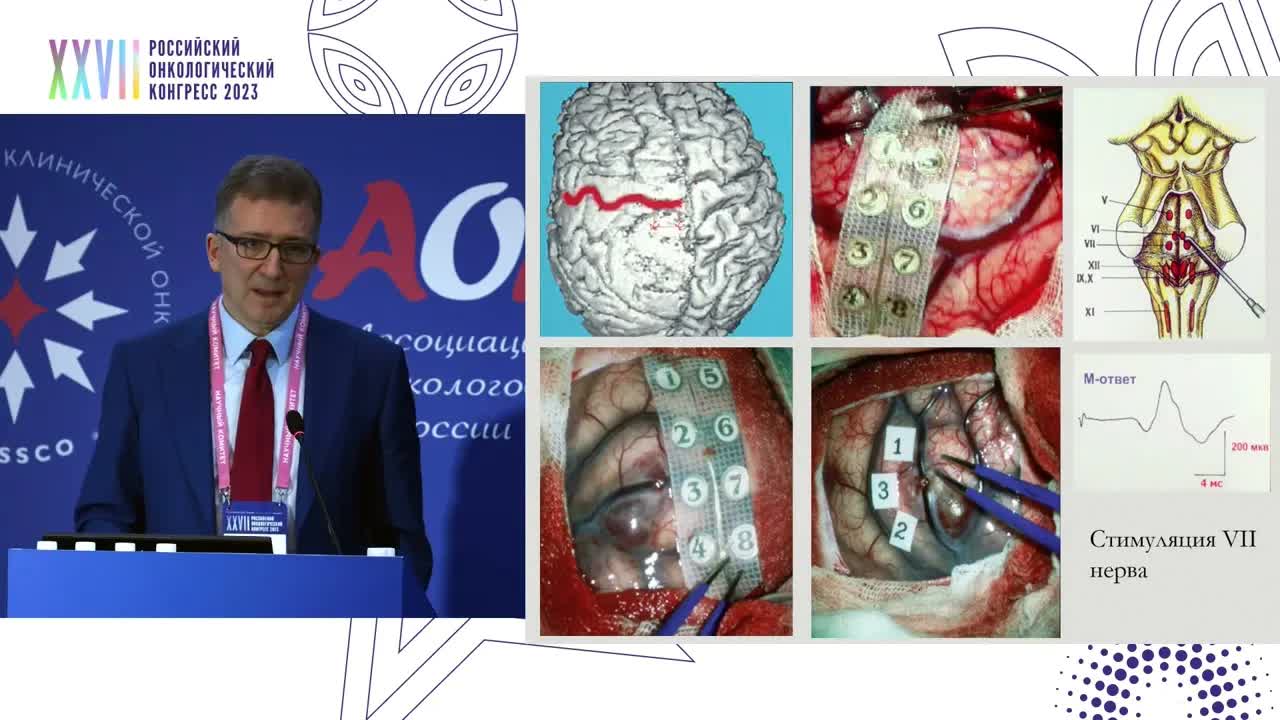 Хирургия злокачественных глиом: что нового?