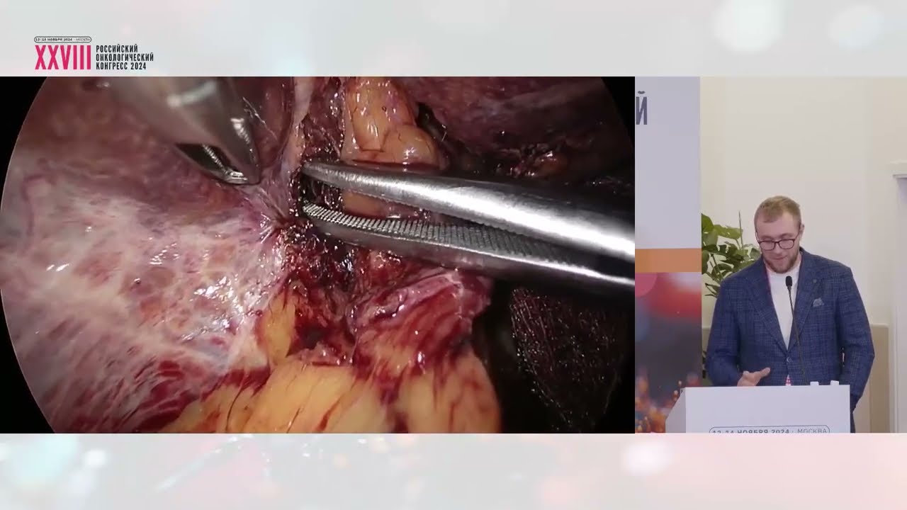 Использование icg в малоинвазивной хирургии колоректальных метастазов в печень, как это делаем мы