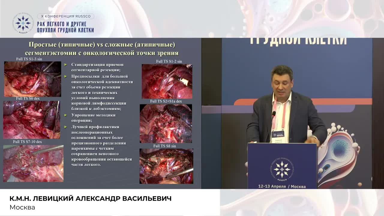 Сегментэктомия vs лобэктомия: будущее или настоящее?