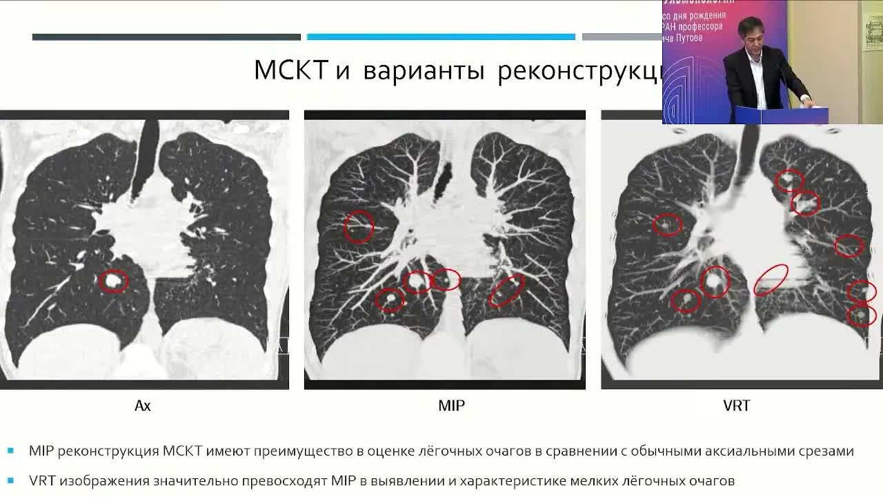 Стратегия лечения метастазов солидных опухолей в легких