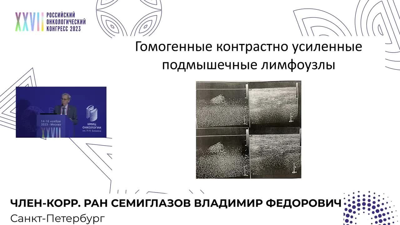 Эволюция БСЛУ – от стадирования до персонификации хирургического этапа в онкологии